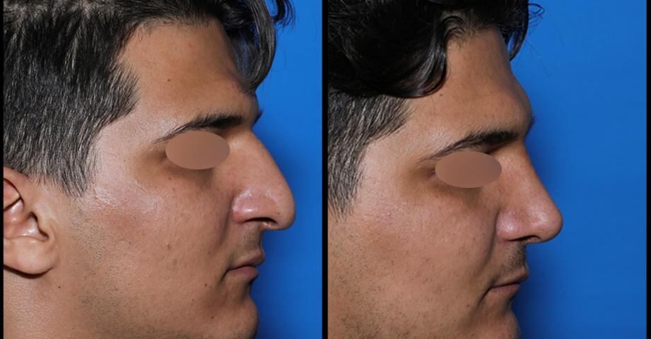 روند بهبودی عمل بینی | زمان‌بندی دقیق روز به روز و هفته به هفته