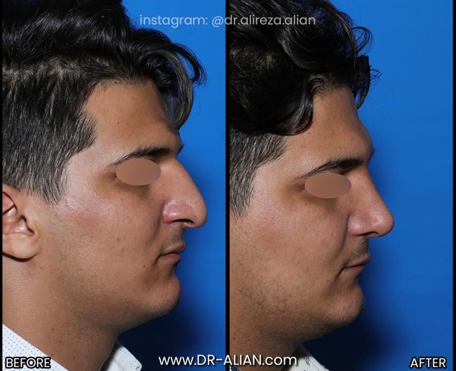 روند بهبودی عمل بینی | زمان‌بندی دقیق روز به روز و هفته به هفته