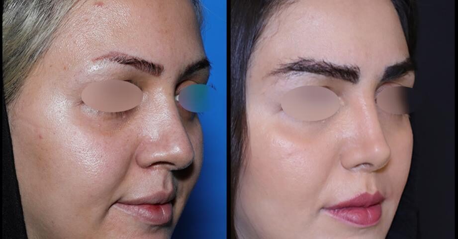 جراحی پولیپ بینی