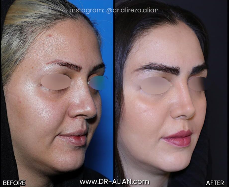 جراحی پولیپ بینی