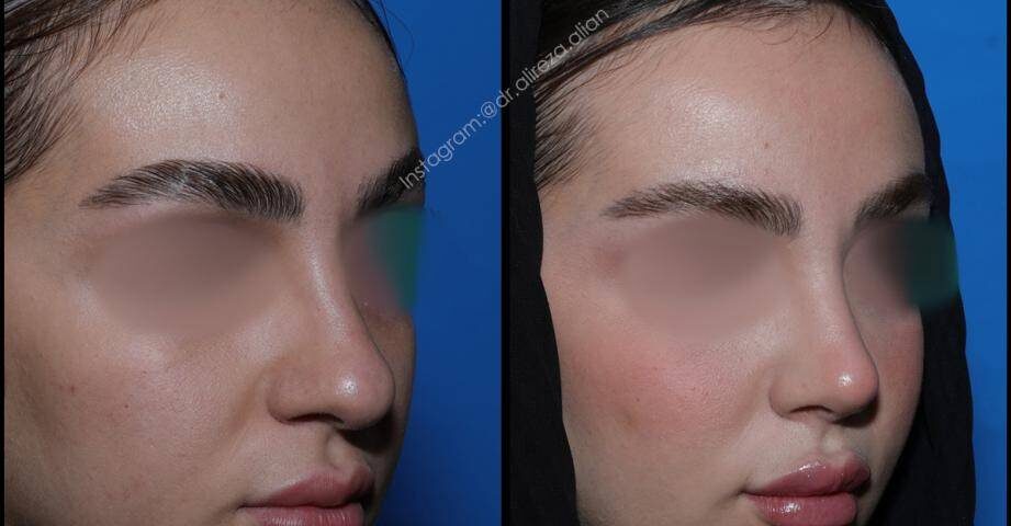 درمان و اصلاح شاخکهای بینی (توربینت)