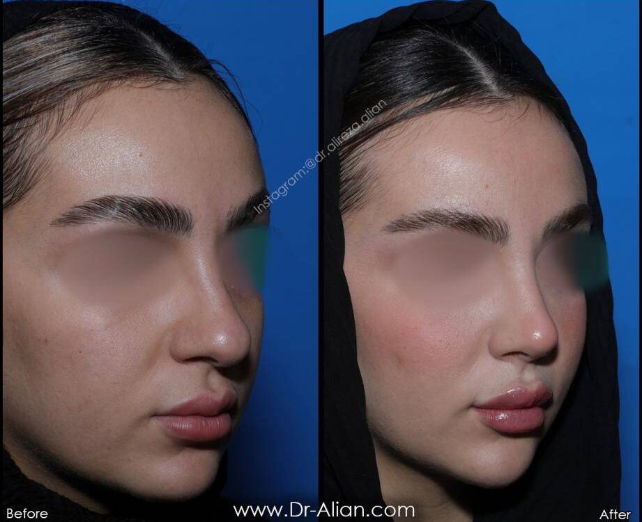 درمان و اصلاح شاخک‌های بینی (توربینت)