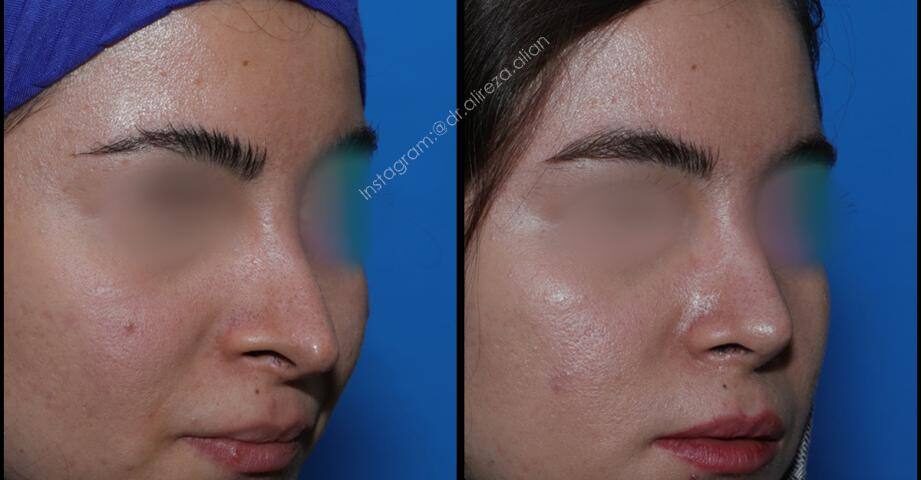 بهترین فرم بینی زنانه