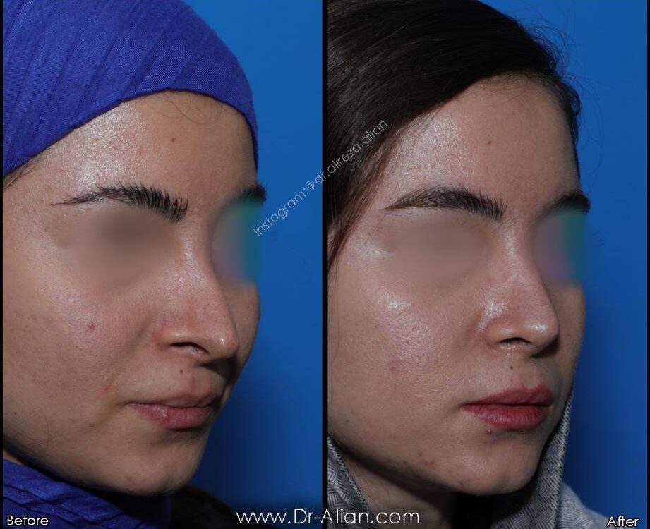 بهترین فرم بینی زنانه