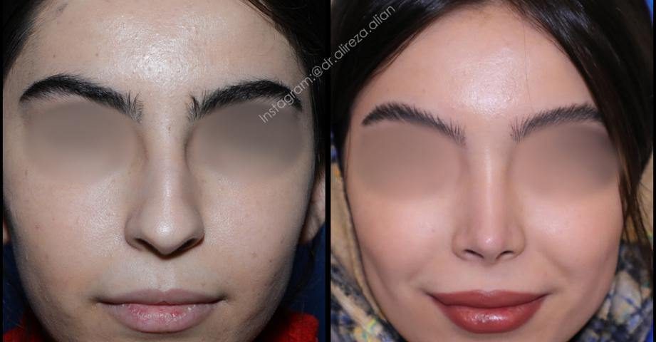 بینی نیمه فانتزی با نوک گرد