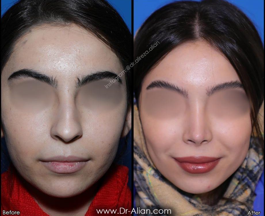 بینی نیمه فانتزی با نوک گرد