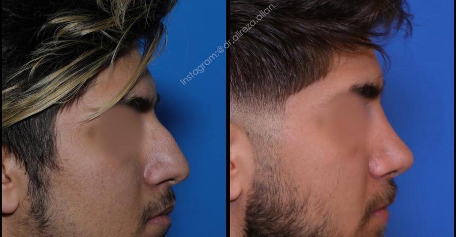 ضخامت پوست در عمل بینی