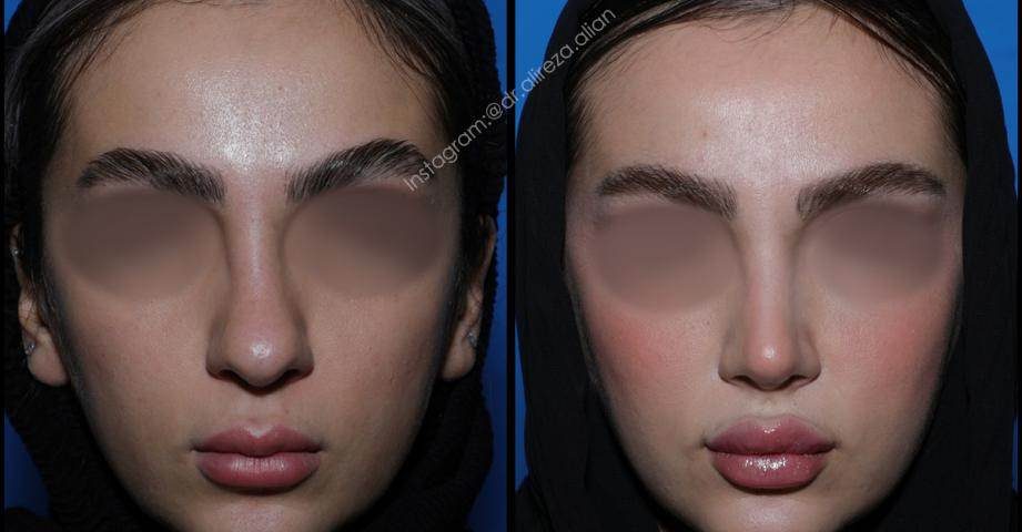 عمل بینی به روش بسته دکتر عالیان