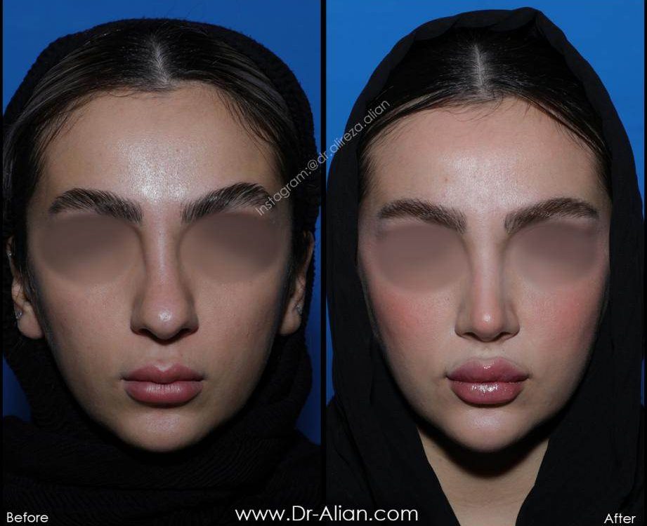 عمل بینی به روش بسته دکتر عالیان