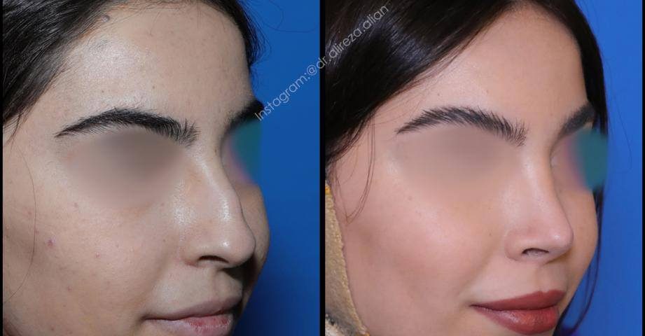 عمل بینی نوک افتاده