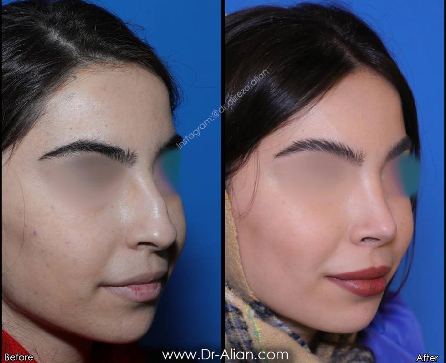 عمل بینی نوک افتاده