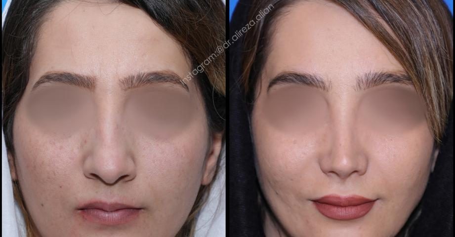 عدم تقارن سوراخ های بینی