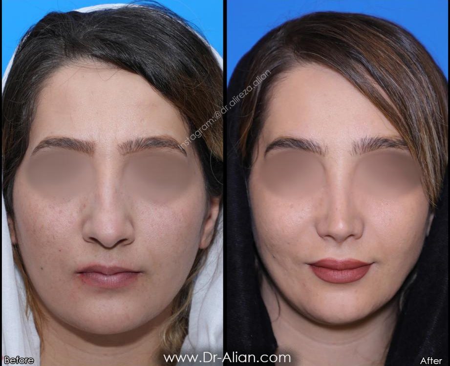 عدم تقارن سوراخ های بینی