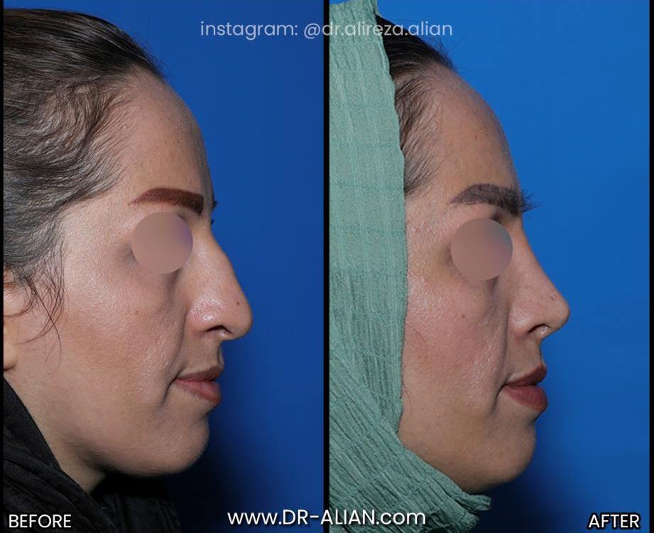نکروز بینی