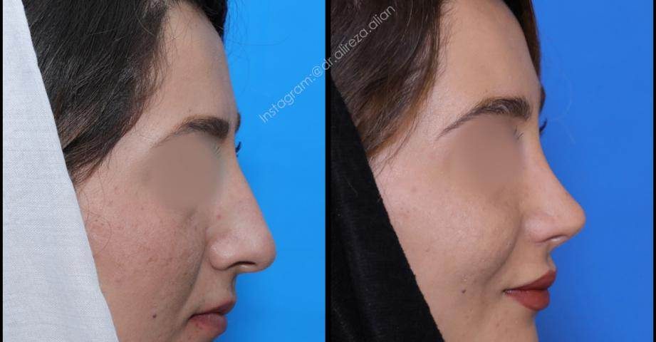 تفاوت بینی گوشتی و استخوانی