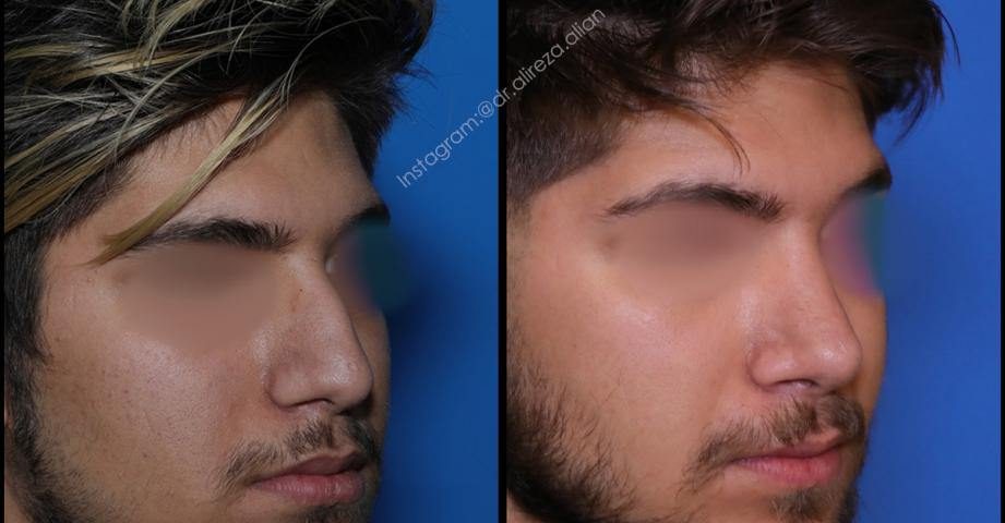 جراحی بینی در افراد سیگاری