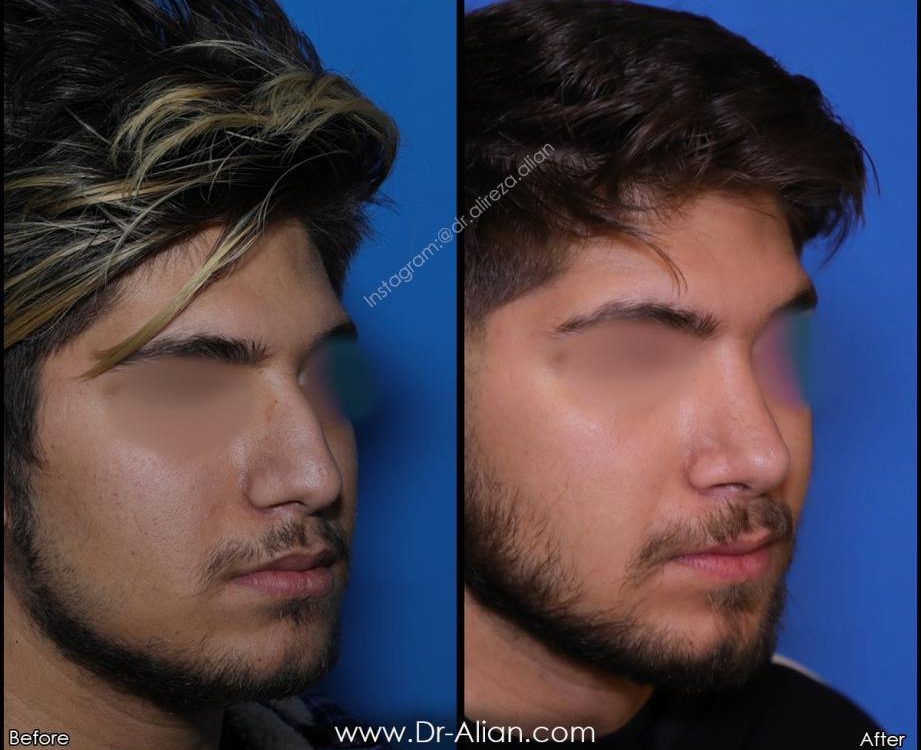 جراحی بینی در افراد سیگاری