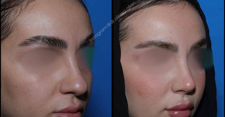 فرق ورم، فیبروز و برگشت بینی بعد از عمل چیست؟