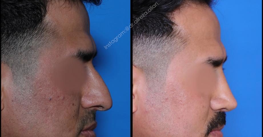 تفاوت انحراف بینی و پولیپ بینی چیست؟