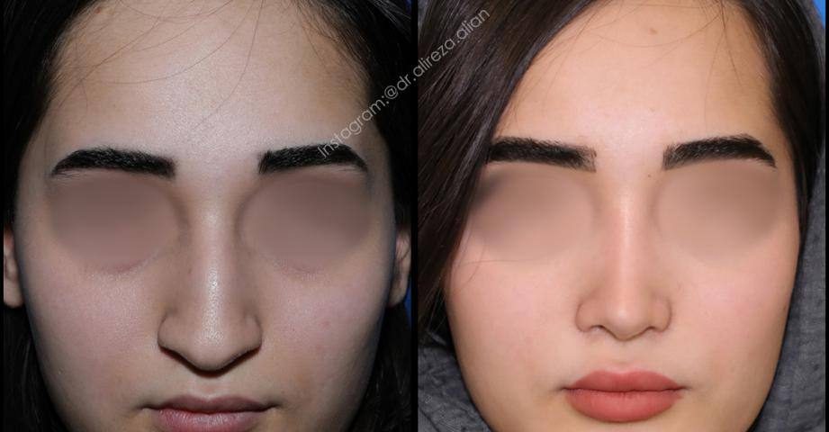 بهترین مدل بینی برای صورت گرد، کشیده و بیضی | راهنمای انتخاب