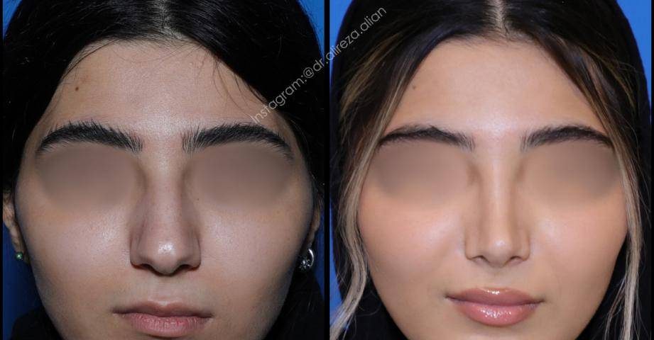 تغذیه بعد از عمل بینی