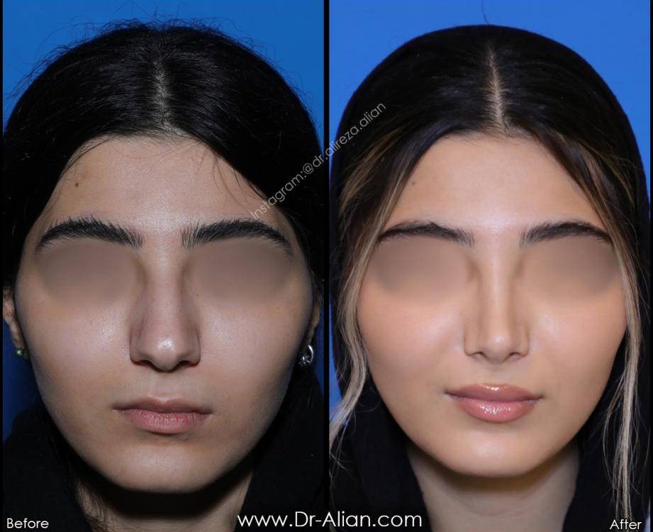 تغذیه بعد از عمل بینی